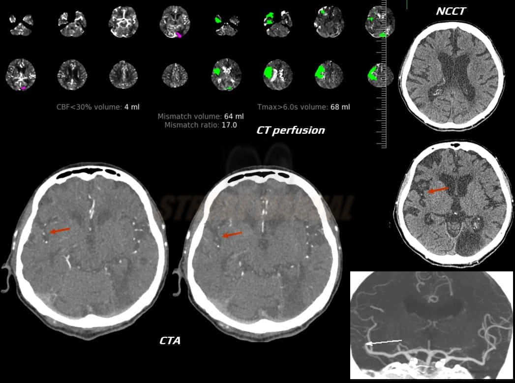 CT perfusion in patient with MCA stroke