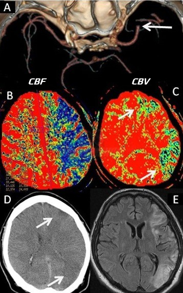Left MCA occlusion with CBF deficit (B) and areas with low CBV (C) showing core. IV thrombolysis led to rapid recanalisation, so NCCT and MRI control show infarction in regions of presumed core.