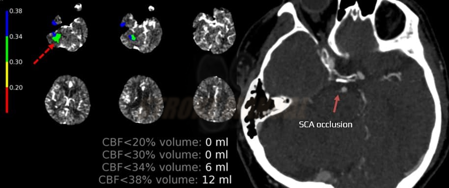 CTP in patient with SCA occlusion