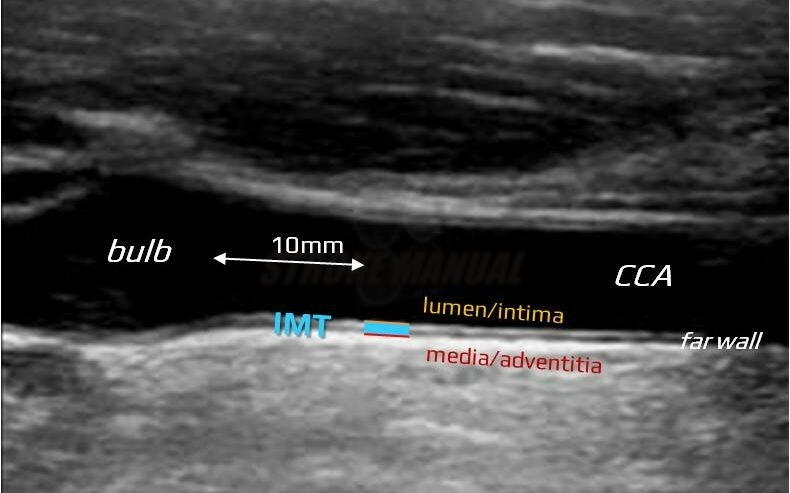 Intima-media thickness (ultrasound image)