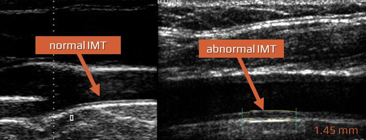 Intima-media thickness (IMT) on ultrasound imaging