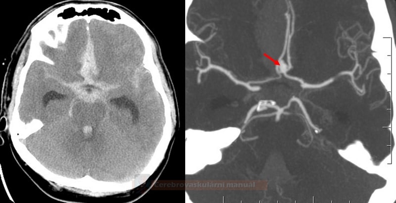 SAH caused by AComm aneurysm rupture