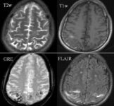 Subarachnoid hemorrhage on MRI