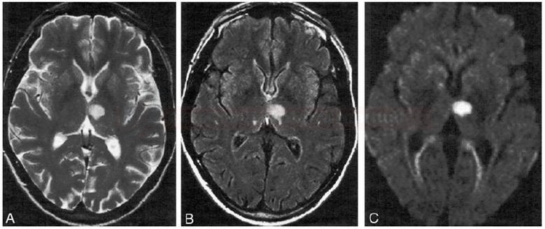 Male 75 years with short lasting mild rightsided hemiparesis. According to new definition it is a stroke with transient symptoms , not TIA