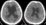 Acute obstructive hydrocephalus before and after external ventricular drain