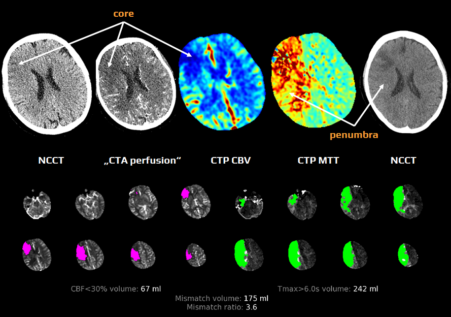 CTP mismatch and final infarction after succesfull recanalisation of dominant M2 occlusion