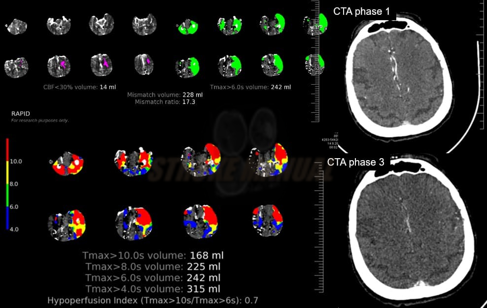 Unfavourable hypoperfusion index (70%), with poor collaterals on multi-phase CTA (mCTA)