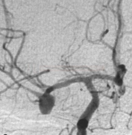 A saccular aneurysm of a middle cerebral artery (MCA)