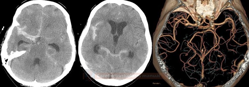 SAH caused by MCA aneurysm rupture