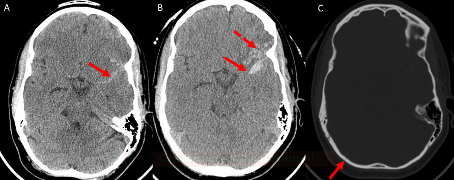 Traumatic SAH - initila NCCT (A), CT control in 24hrs (B), calval fissura in bone window (C)