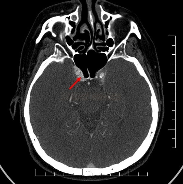 Direct carotid-cavernous fistula (CCF) type A on CT angiography