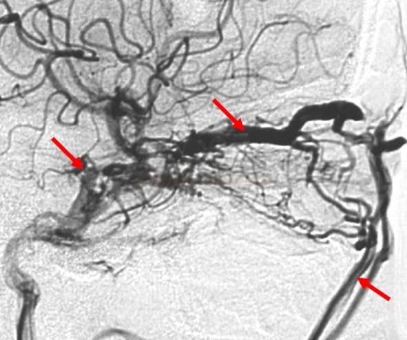 Direct CCF with rapid filling of ophtalmic veins on DSA