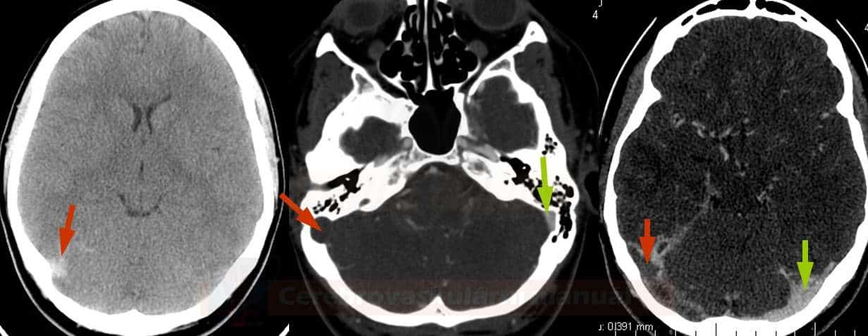 Hyperdense sign on NCCT (left), CT venography with defective contrast filling of the right transverse and sigmoid sinuses