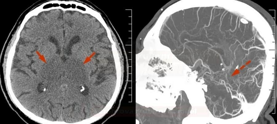 The straight sinus thrombosis with bithalamic venous infarction