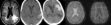 Cerebral amyloid angiopathy