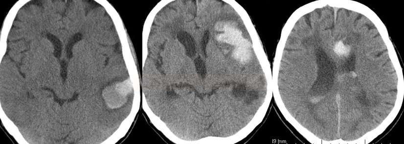 Cerebral amyloid angiopathy with repeated lobar hematomas