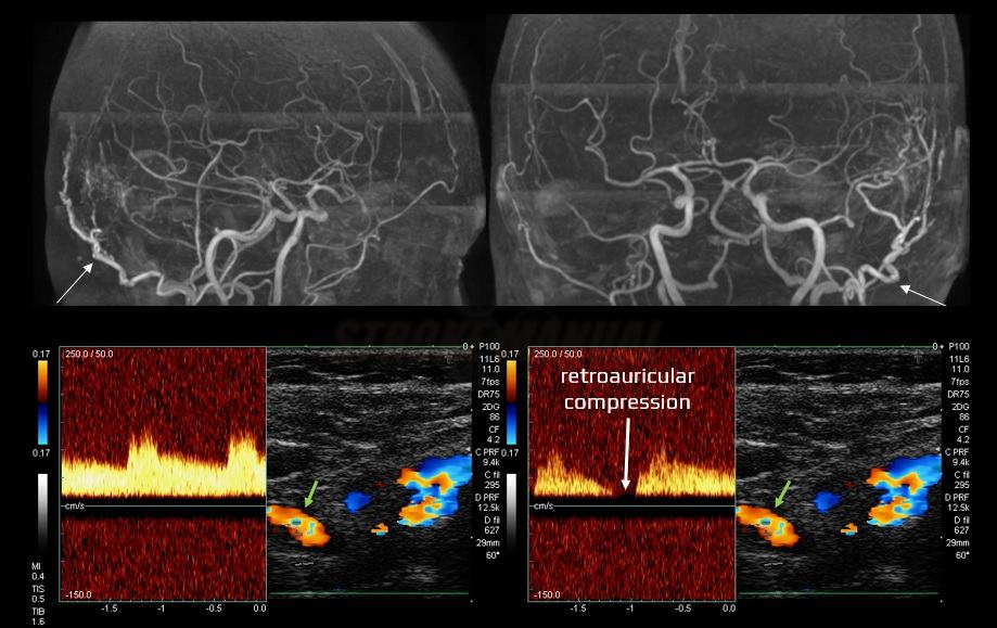 ECA monitoring during retroauricular compression of the feeding occipital artery