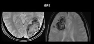 Hyperacute hemorrhage on GRE - extent of hypointensity depends on deoxyhemoglobin content