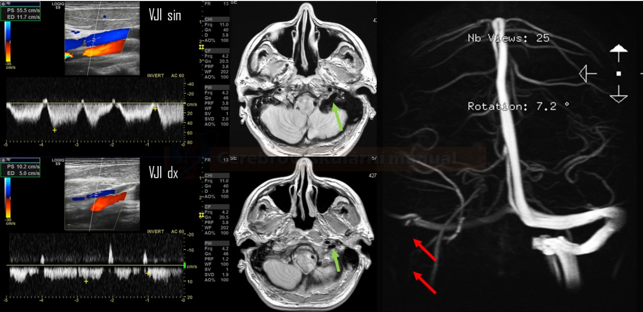 Occlusion of the right sigmoid sinus and IJV