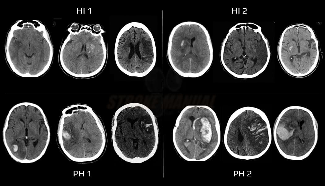 Hemorrhage classification after stroke/reperfusion (ECASS II)
