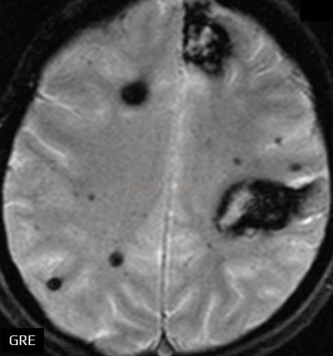 Cortical cerebral microbleeds and lobar hematomas in patient with cerebral amyloid angiopathy