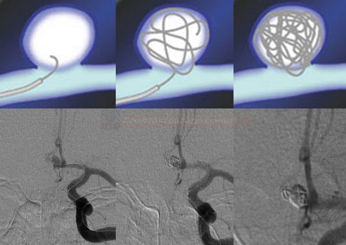 The course of aneurysm sac embolization with coils