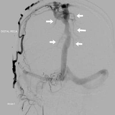 DSA showing fistula between superficial temporal artery and superior sagittal sinus. White arrow show reflux from sinus to cortical veins