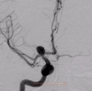 Aneurysm of the distal segment of ICA
