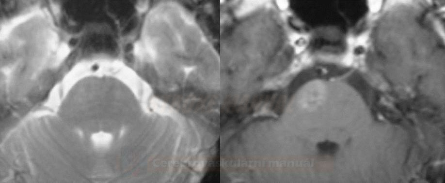 Brainstem capillary telangiectasia on T2 (left) and T1C+ (right) sequencies