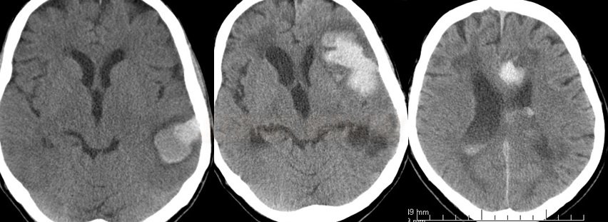 Repeated lobar hematomas in patient with CAA