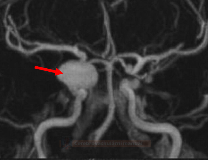 ICA aneurysm on MRA