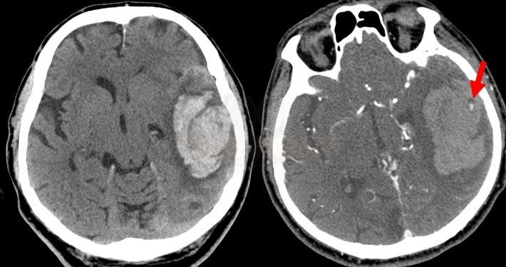 Parenchymal hematoma on NCCT (left), spot sign on CT angiography (right)