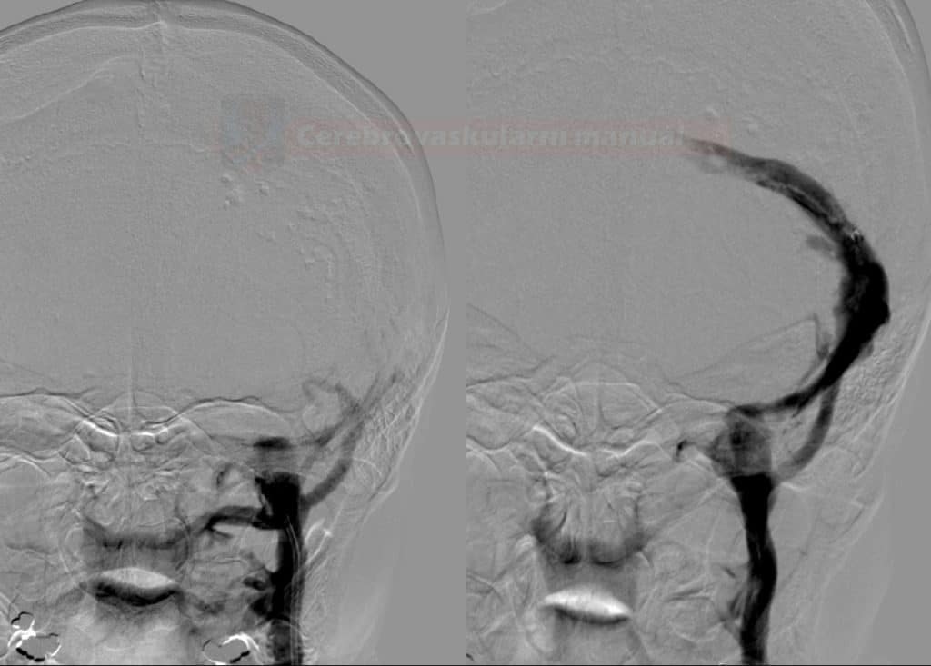 Successful recanalization of the transverse sinus with the Penumbra catheter. Sagittal sinus remained obstructed despite repeated attempts
