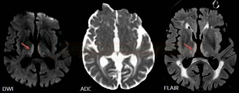 T2 shine through in a patient with Wernicke's encephalopathy