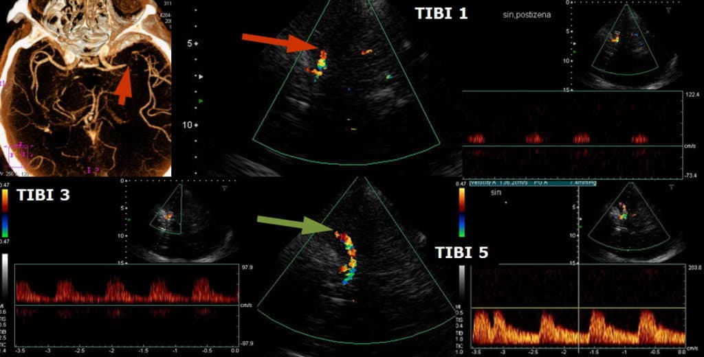 TCCD monitoring during intravenous thrombolysis - complete recanalization of occluded MCA was achieved