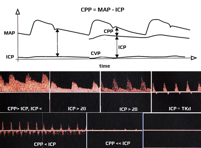 TCCD in cerebral circulatory arrest (CCA) detection
