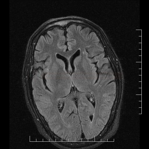 Posterior Reversible Encephalopathy Syndrome (PRES)
