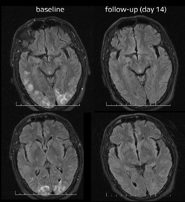PRES - MRI baseline and follow-up