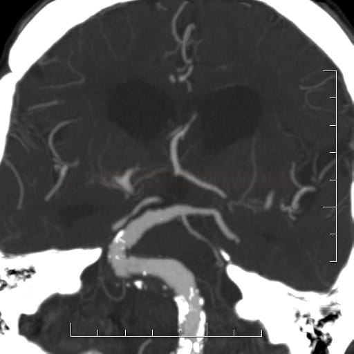 Basilar artery dolichoectasia (CTA)
