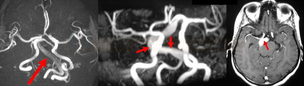 Dolichoectasia of basilar artery on MRA