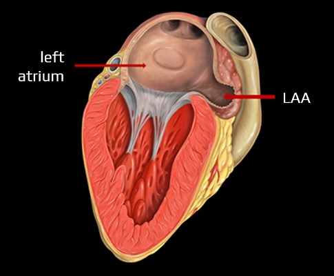 Left atrial appendage (LAA)