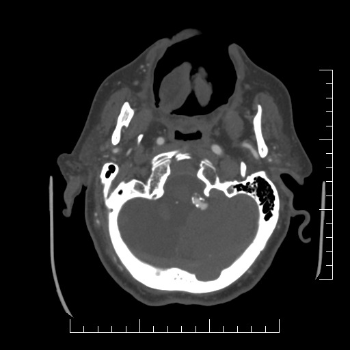Basilar artery dolichoectasia on CTA