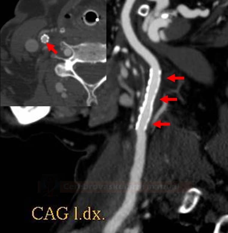 Carotid angioplasty and stenting - follow up CTA
