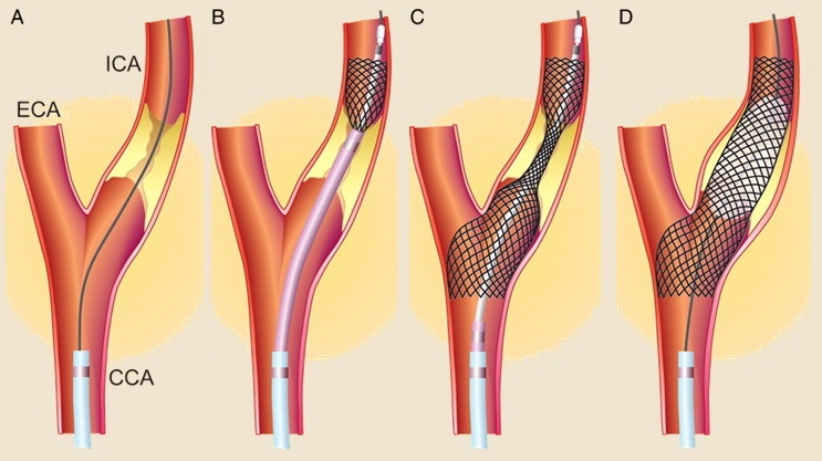 Carotid angioplasty with stenting
