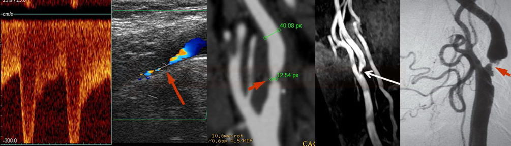 Carotid artery stenosis (ultrasound, CTA, MRA, DSA)