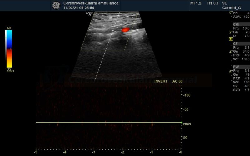 Stent thrombosis on the ultrasound examination