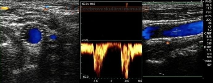 Ultrasound follow up after CAS