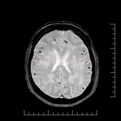 Cerebral amyloid angiopathy (CAA) on GRE