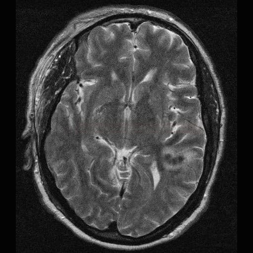 Cerebral amyloid angiopathy (CAA)