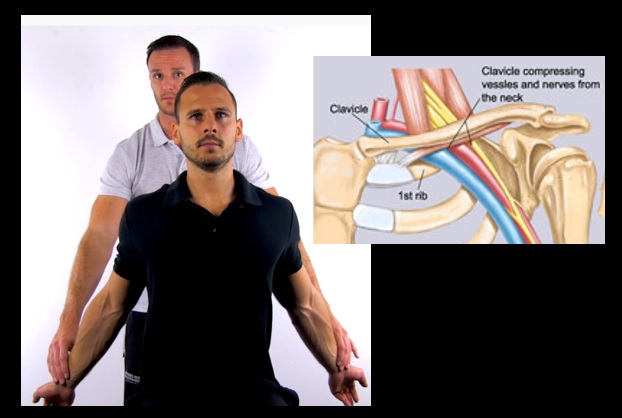 Thoracic Outlet Syndrome (TOS) | STROKE MANUAL